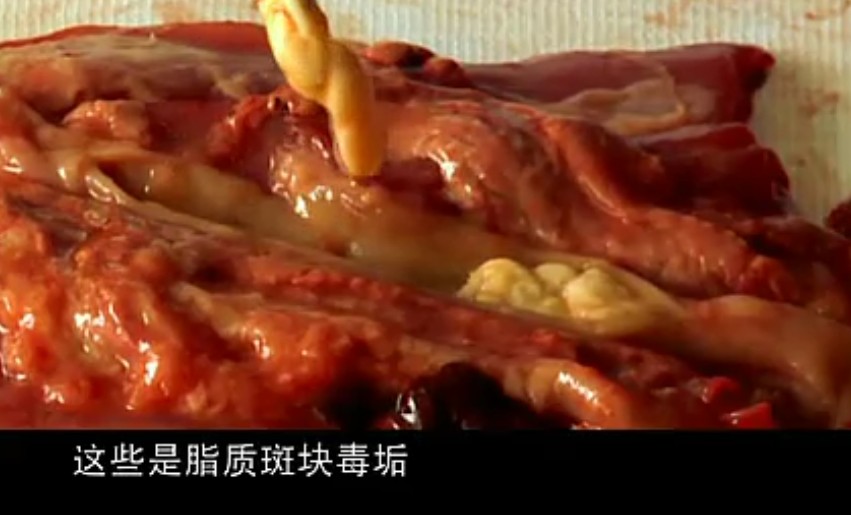 再解剖一个被严重堵塞的血管,除了脂质斑块毒垢还有成几厘米的