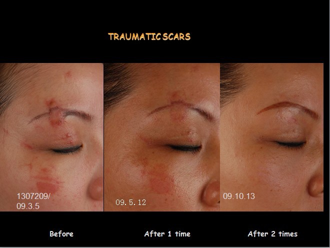 二氧化碳(co2)激光治疗是什么瘢痕的“克星”——超脉冲co2点阵激光_https://www.jmylbn.com_新闻资讯_第9张