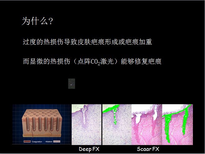 二氧化碳(co2)激光治疗是什么瘢痕的“克星”——超脉冲co2点阵激光_https://www.jmylbn.com_新闻资讯_第7张