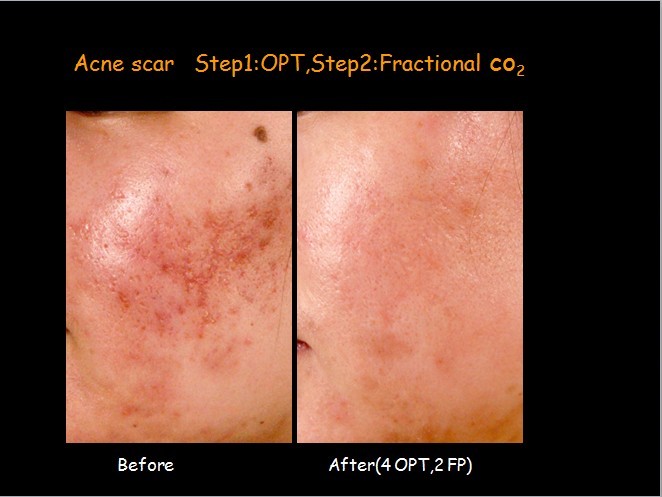 二氧化碳(co2)激光治疗是什么瘢痕的“克星”——超脉冲co2点阵激光_https://www.jmylbn.com_新闻资讯_第11张