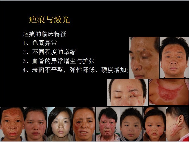 二氧化碳(co2)激光治疗是什么瘢痕的“克星”——超脉冲co2点阵激光_https://www.jmylbn.com_新闻资讯_第3张