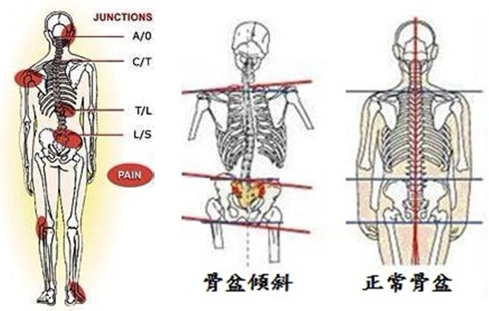 骨盆倾斜是女性百病的根源