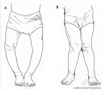导致食物首页 育儿亲子的微信  o型腿或x型腿的形成与缺钙无关,与膝