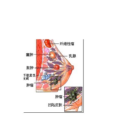 全球最小的乳腺癌患者