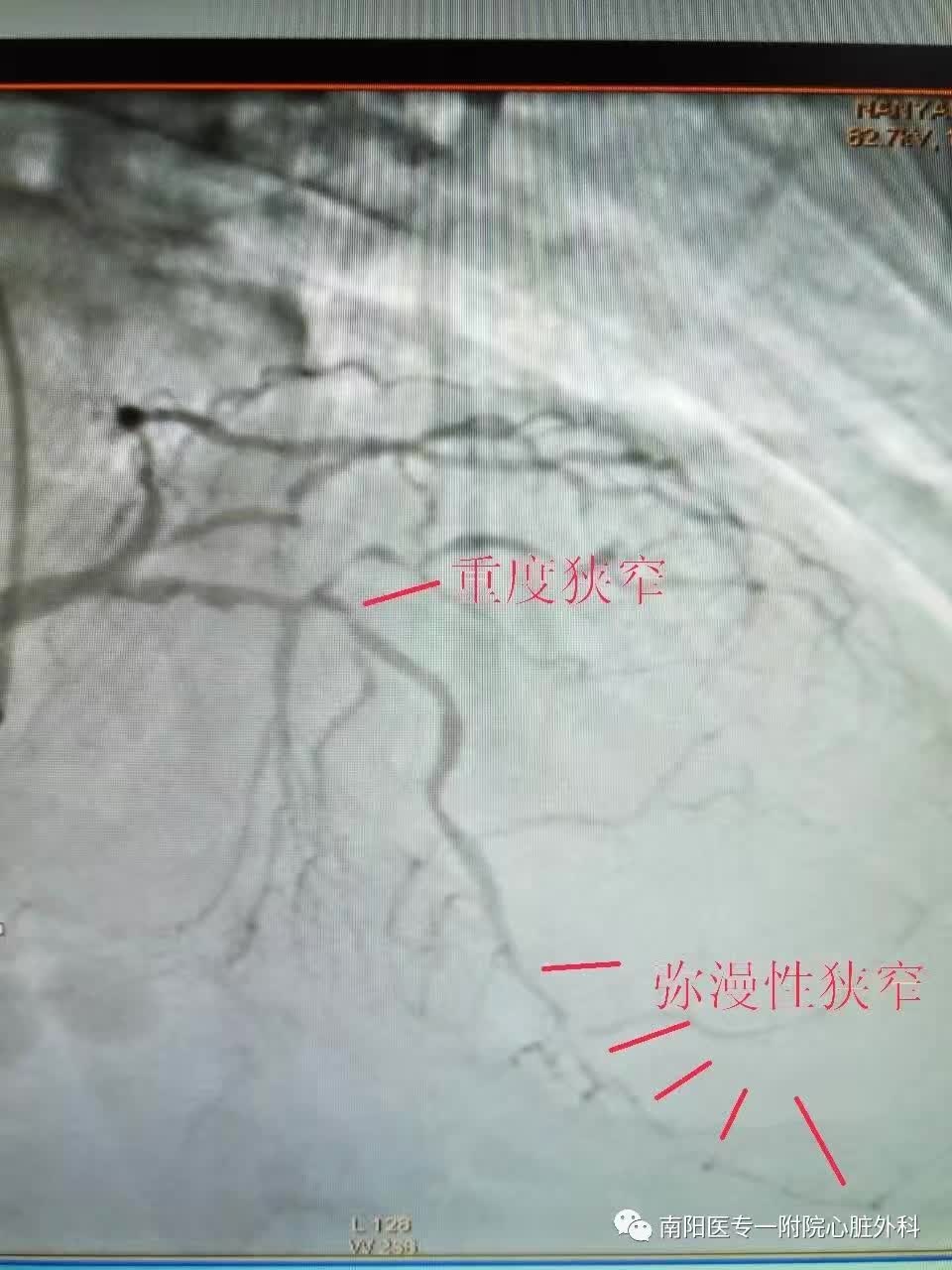严重冠心病患者的保命手术—冠脉搭桥术